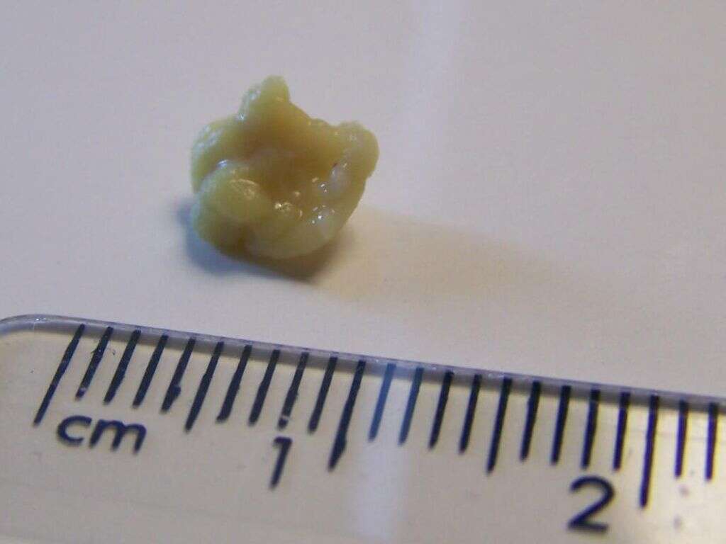 Tonsil Stones