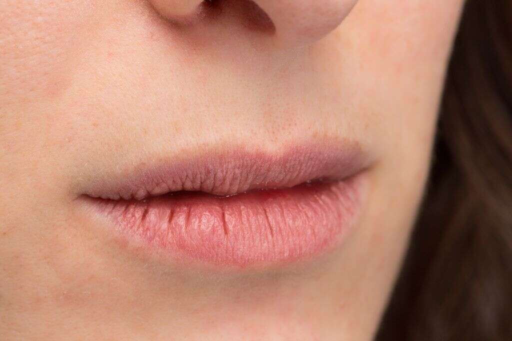 Tonsil Stones