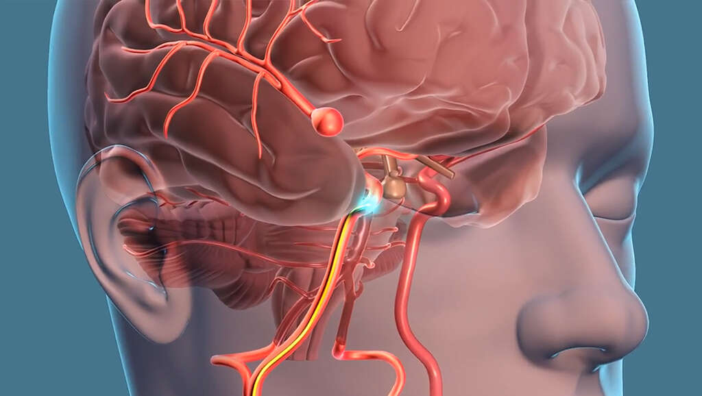 Trigeminal Neuralgia