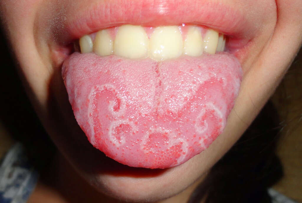 White Tongue