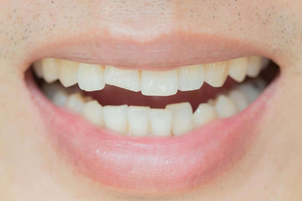 Cavity