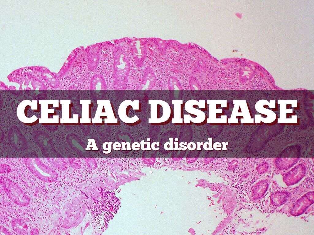 Celiac Disease