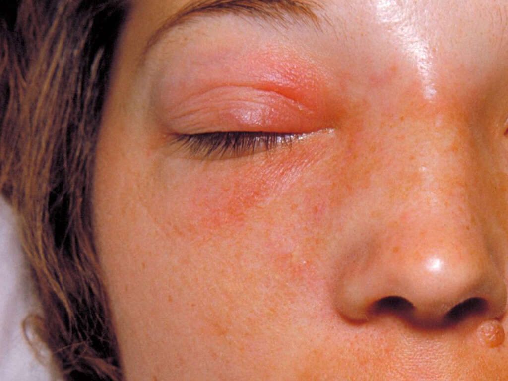 Cellulitis