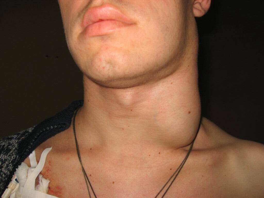 Cellulitis