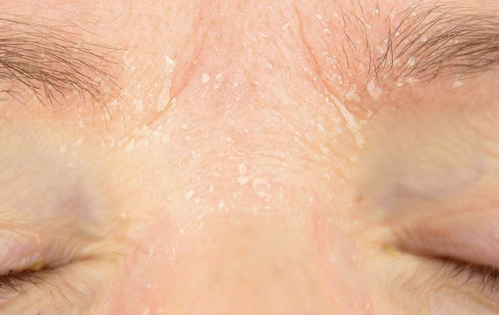Chalazion