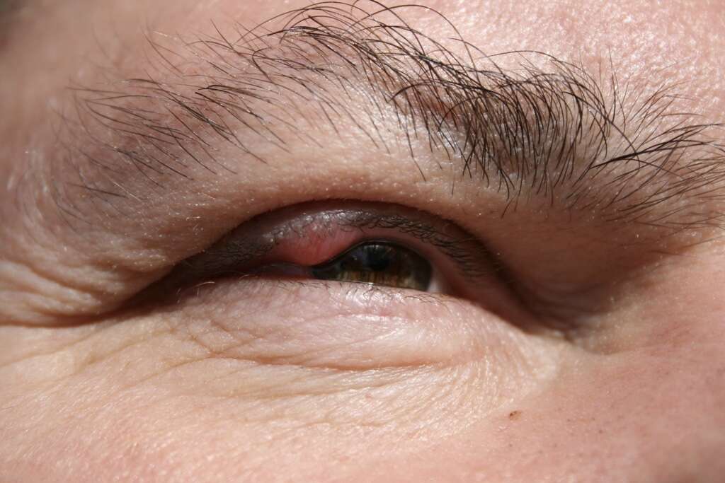 Chalazion