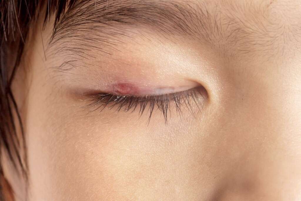 Chalazion