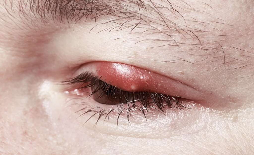 Chalazion