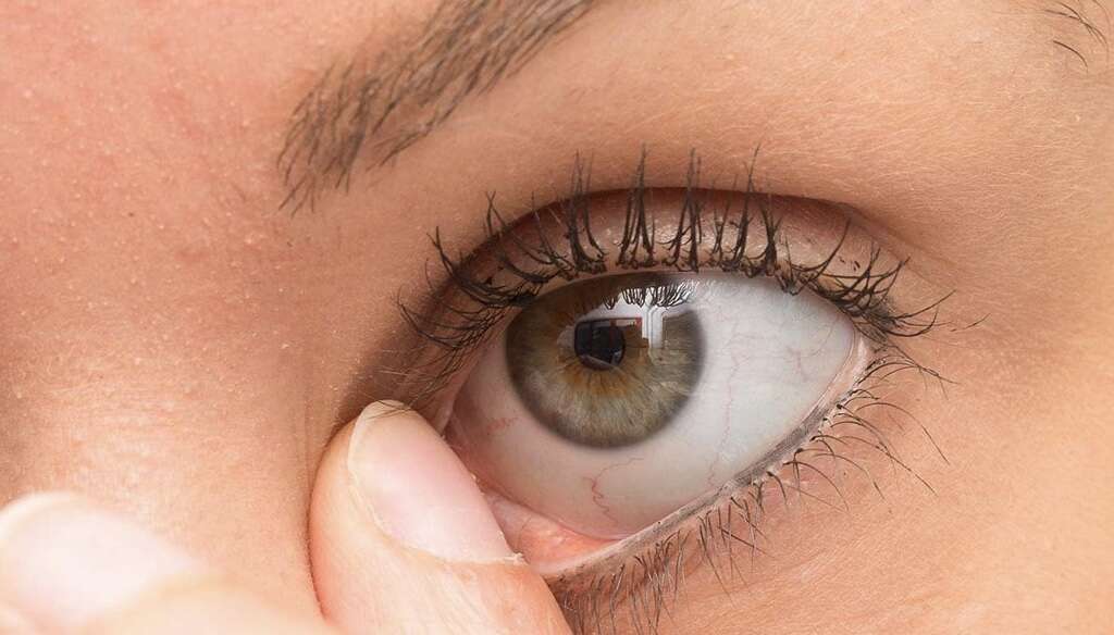 Chalazion
