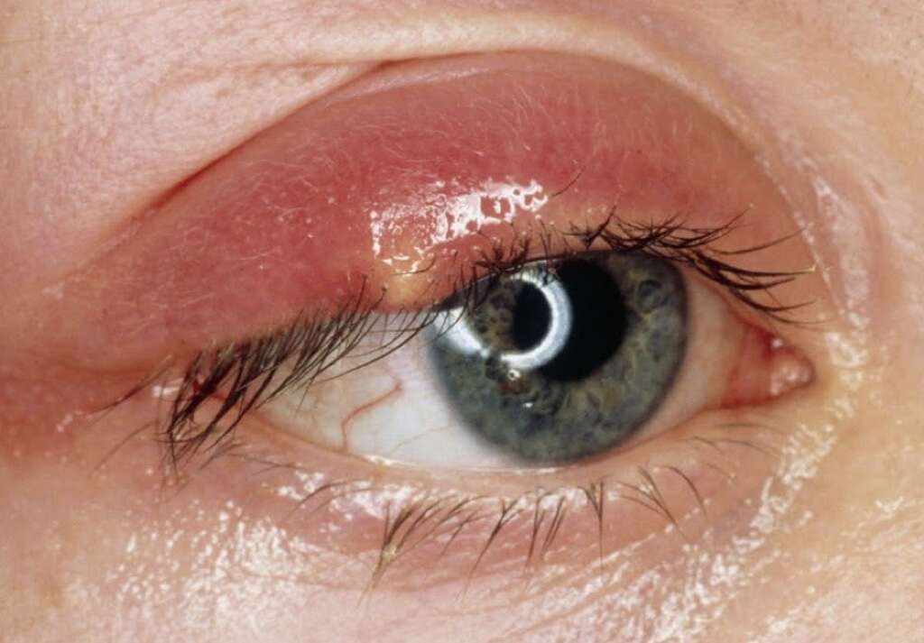 Chalazion 10 Causes Of Chalazion Chalazion 10 Causes Of Chalazion