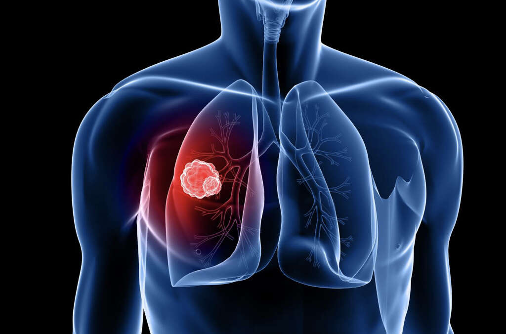 Chronic Cough