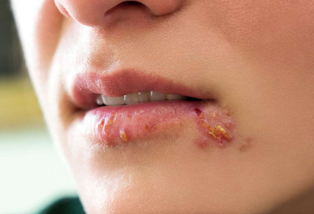 Cold Sore