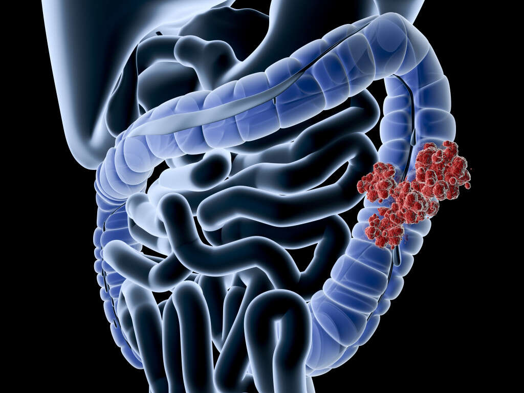 Colon Cancer