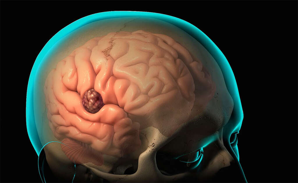Brain Diseases