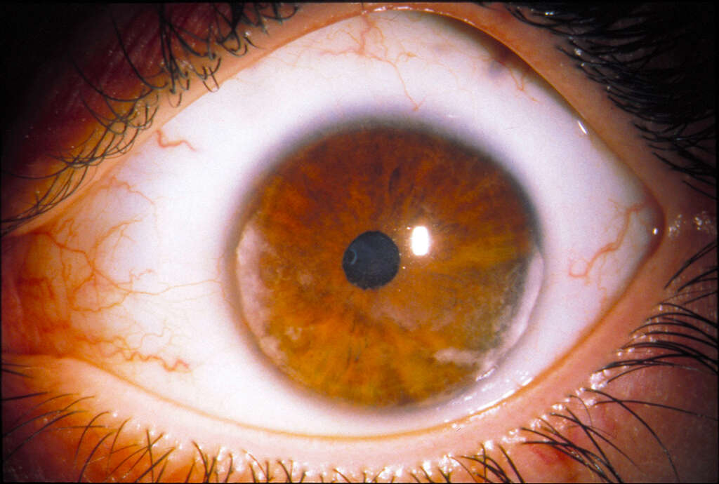 Eye Diseases
