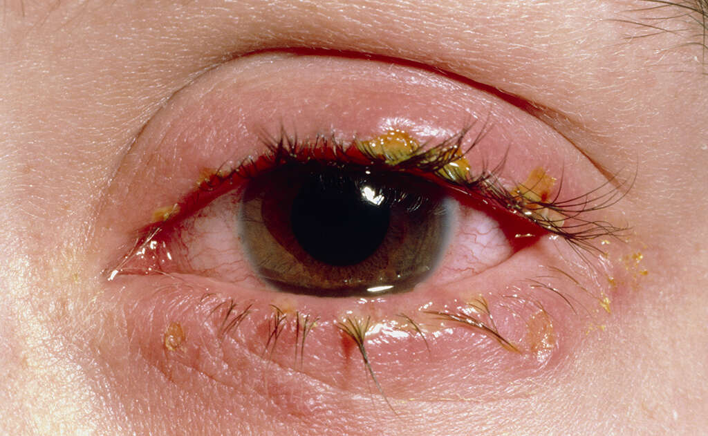 Eye Diseases 10 Common Eye Diseases