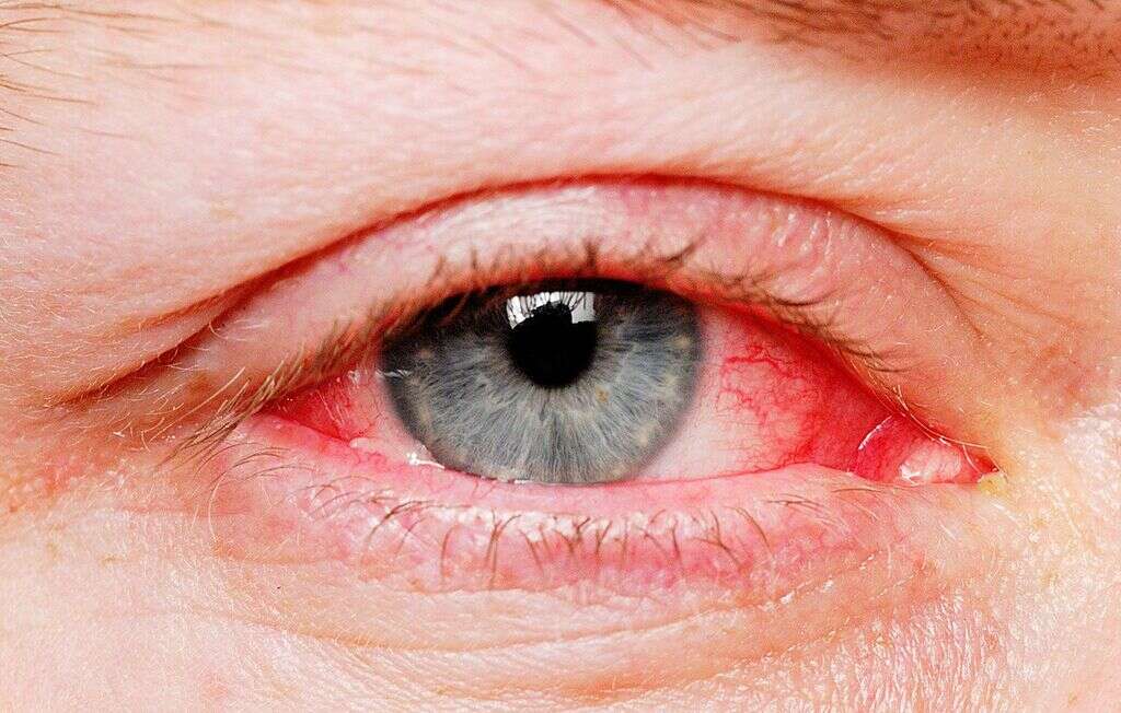 Conjunctivitis