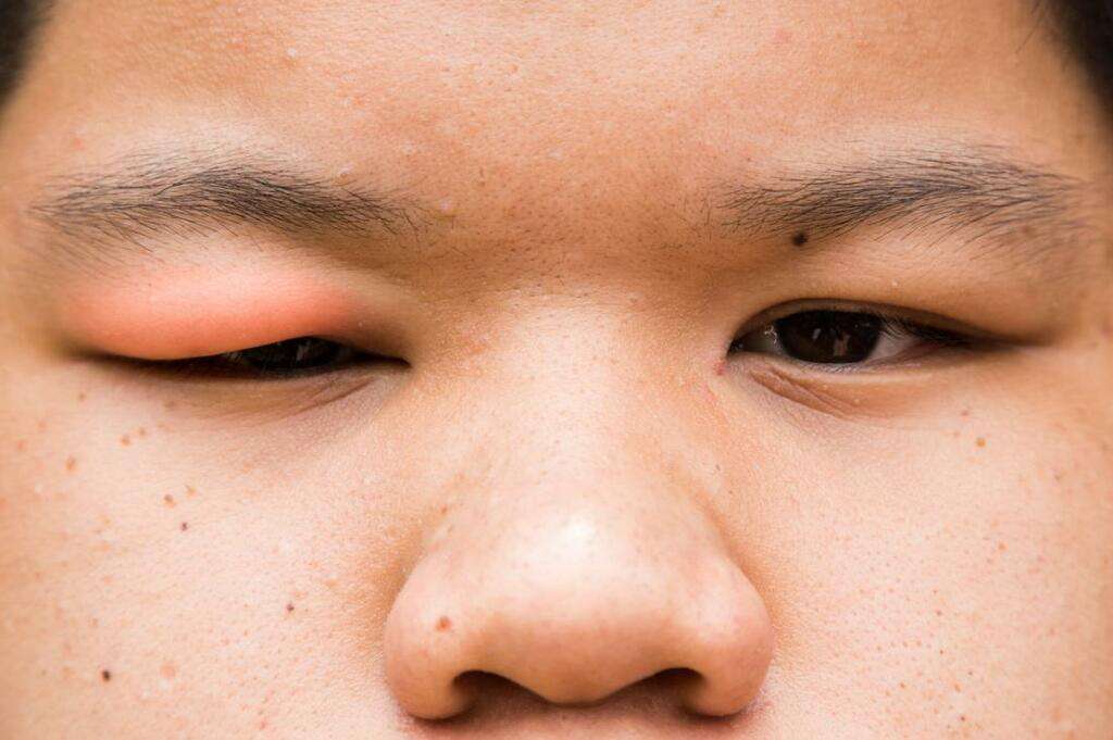 Conjunctivitis
