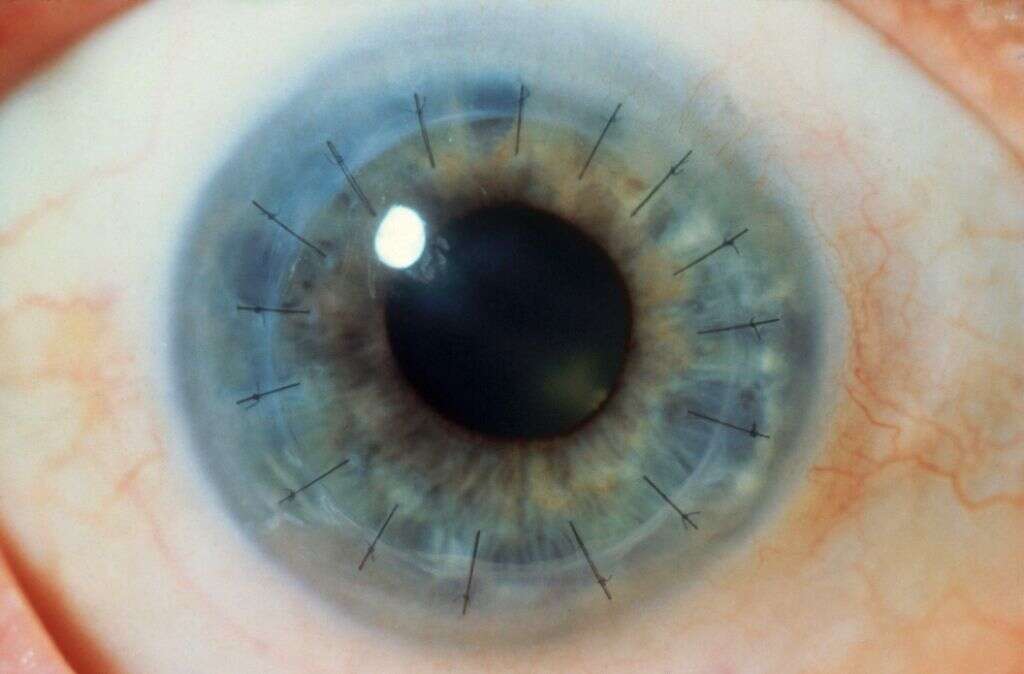 Corneal Ulcer