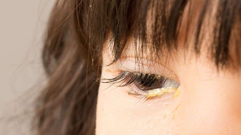 Corneal Ulcer