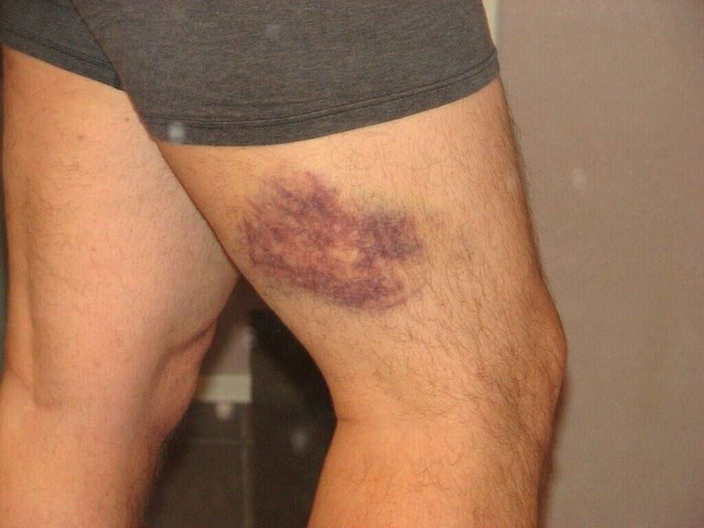 Deep Vein Thrombosis