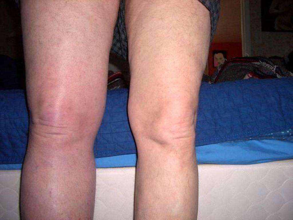 Deep Vein Thrombosis