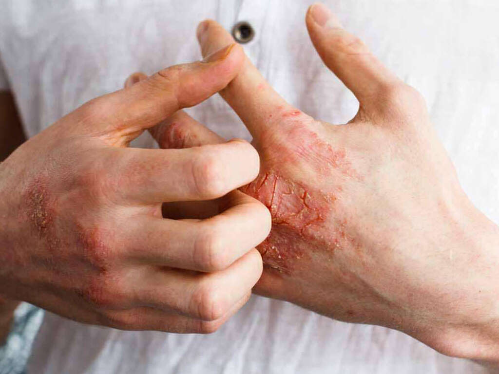 Dermatomyositis