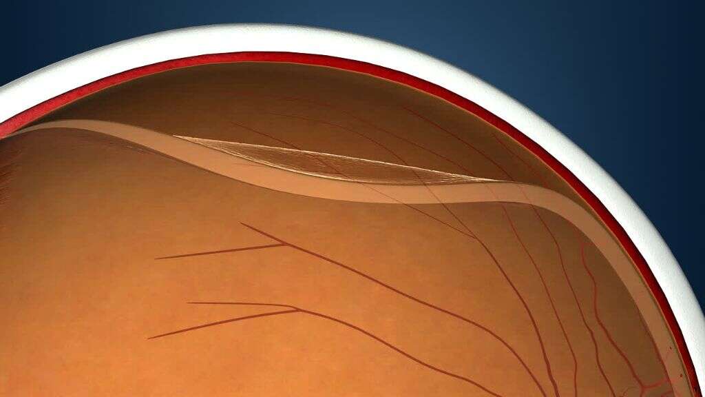 Detached Retina