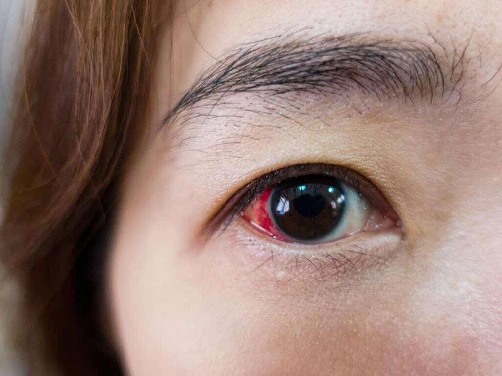 Detached Retina