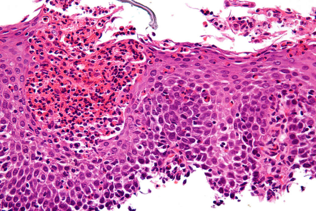 Dysphagia
