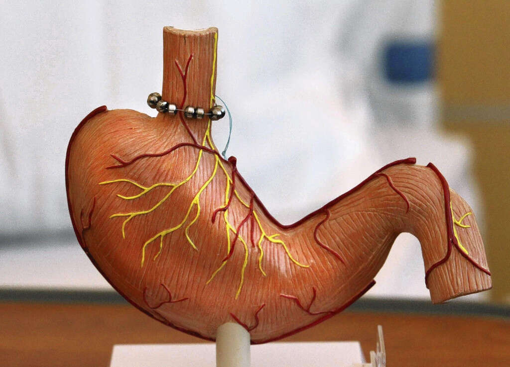 Dysphagia
