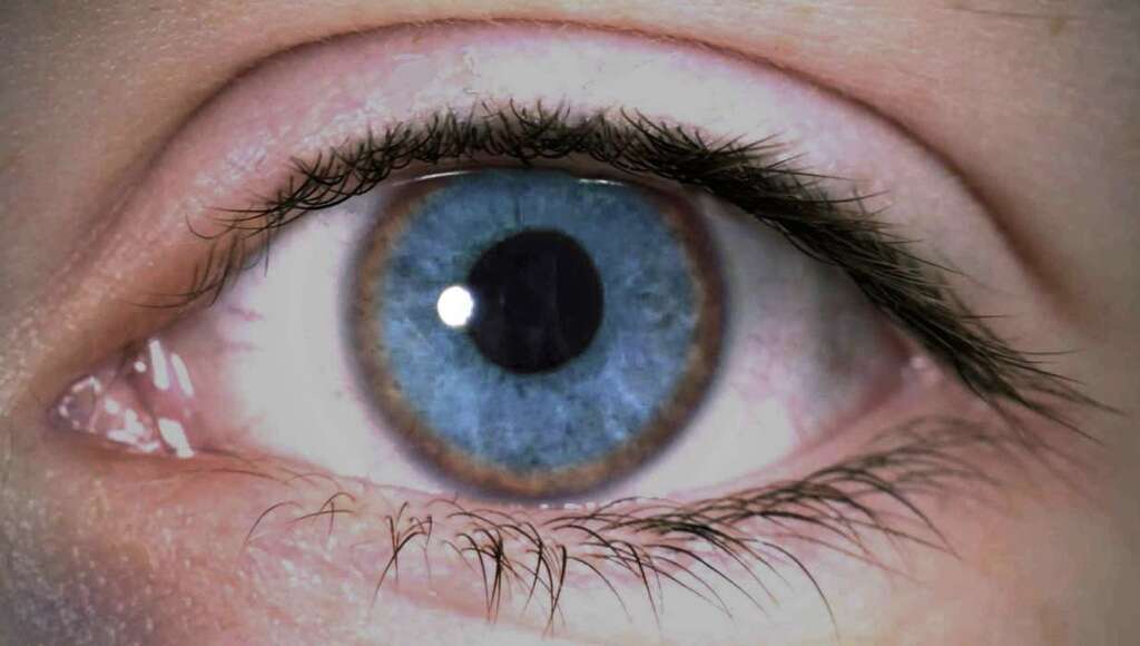 Dystonia