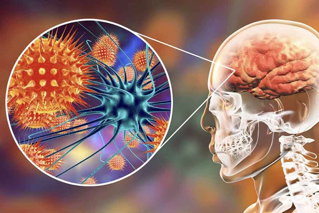 Dystonia
