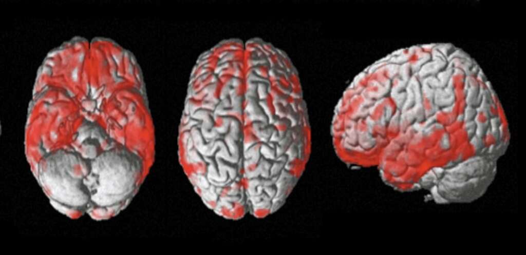 Dystonia