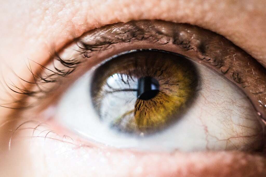 Ectropion
