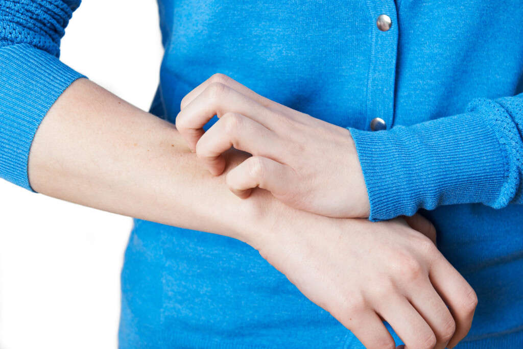 Eczema