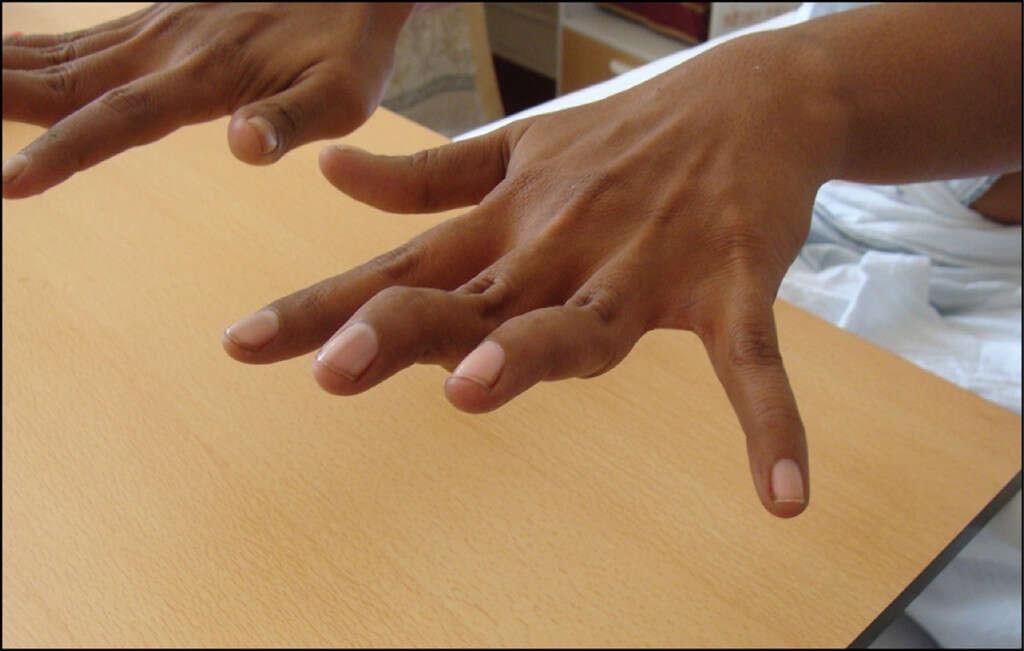 Ehlers Danlos Syndrome