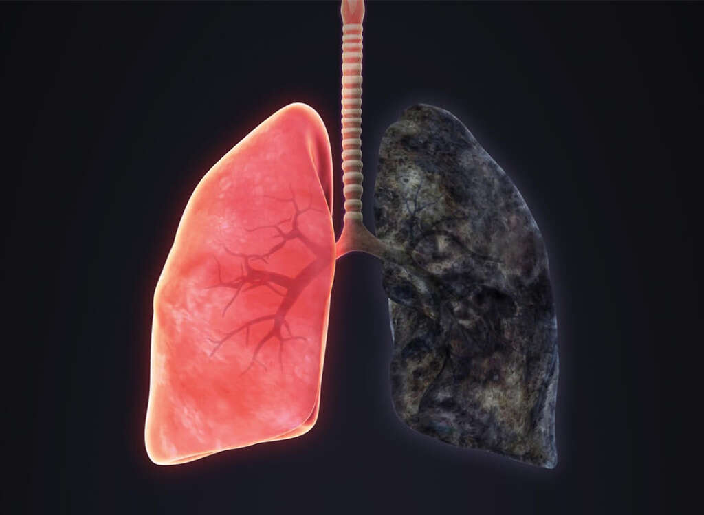 Emphysema
