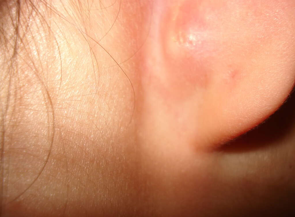 Epstein Barr Virus