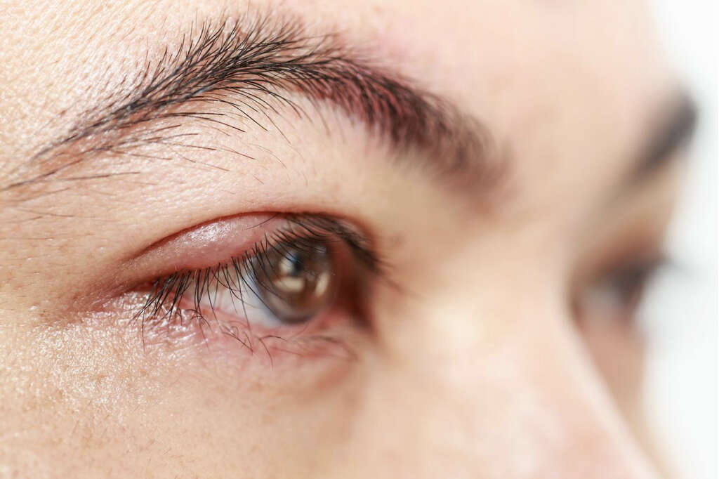 Eye Infection