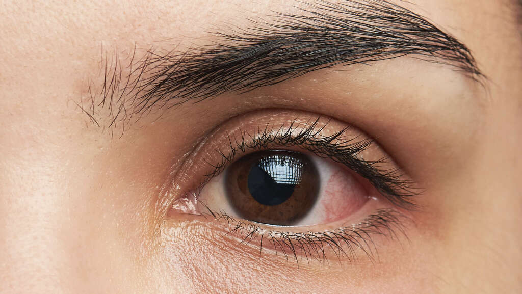 Eye Infection