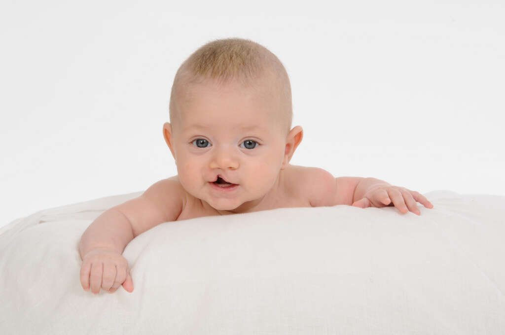 Fetal Alcohol Syndrome