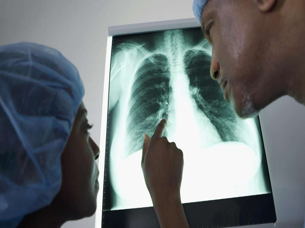 Fluid In Lungs