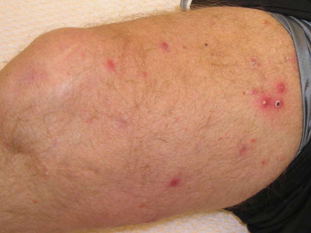 Folliculitis