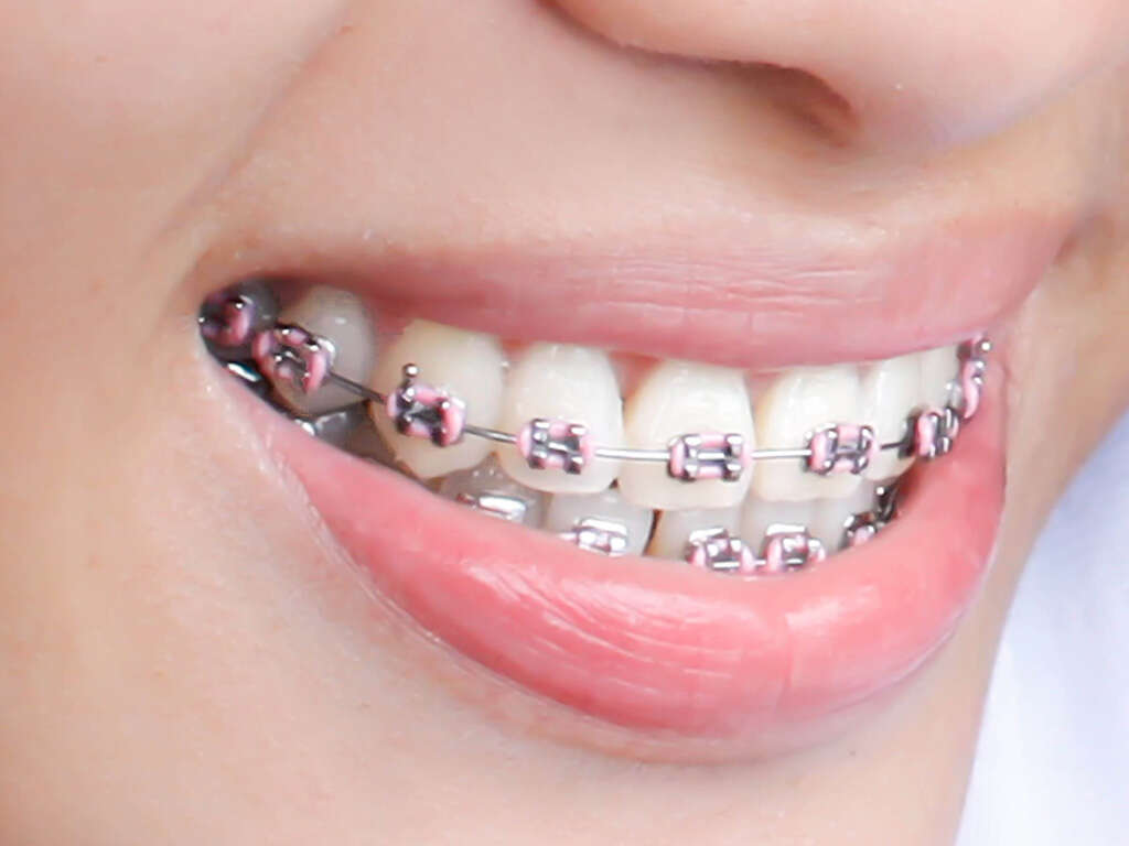 Braces