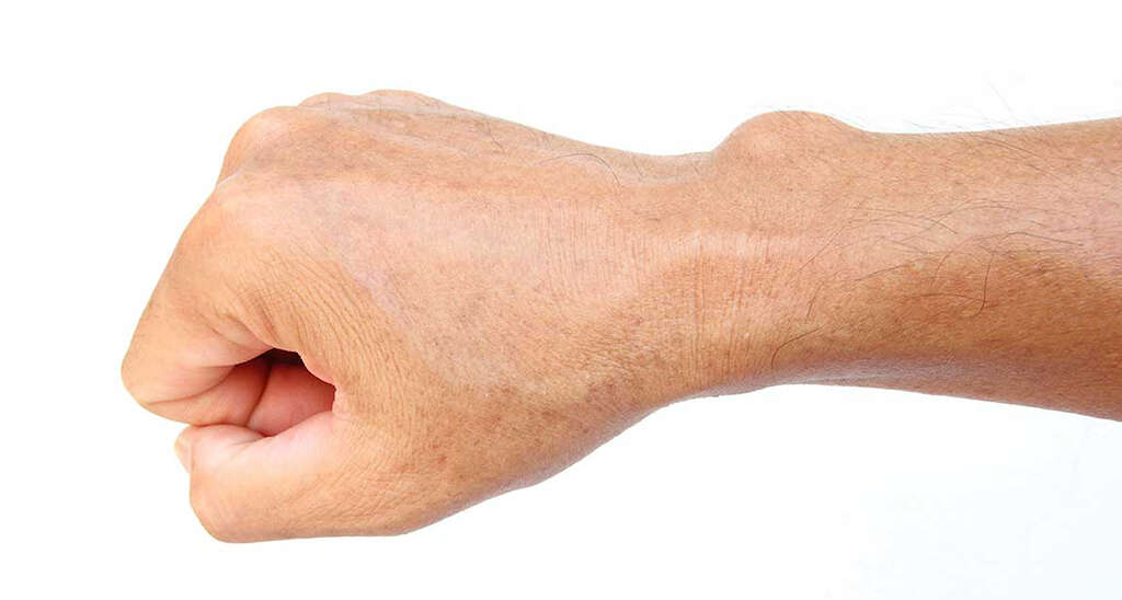 Ganglion Cyst