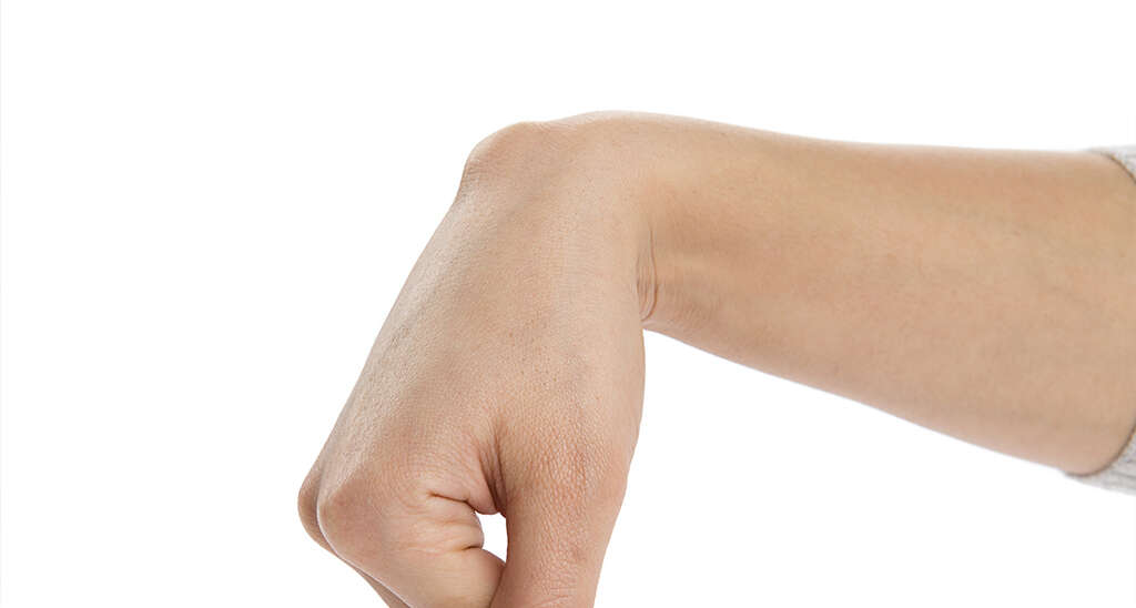 Ganglion Cyst