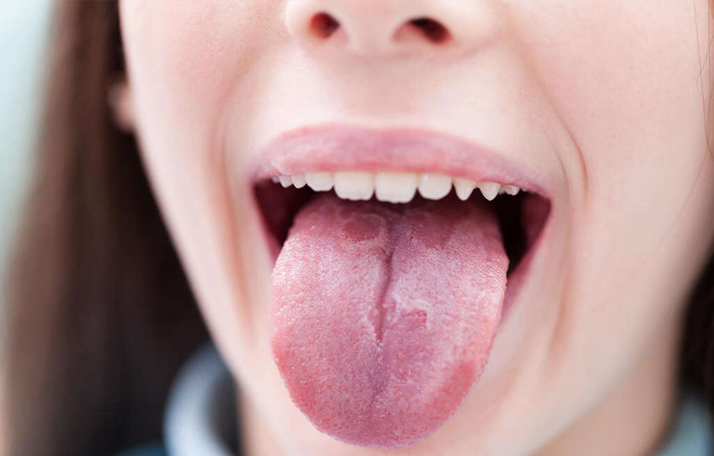 Geographic Tongue