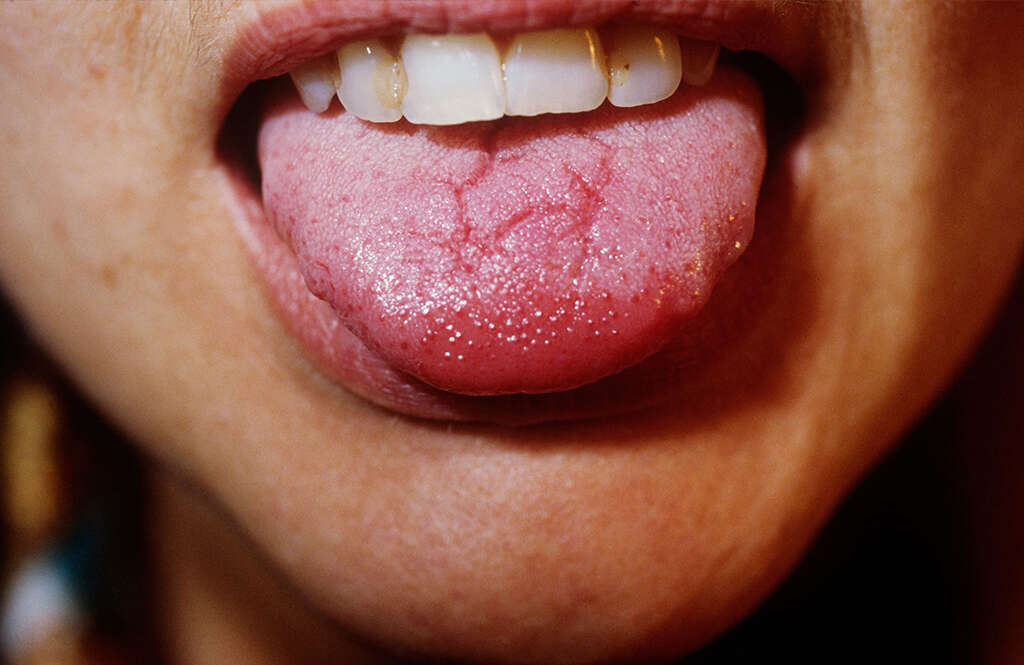 Geographic Tongue 10 Causes Of Geographic Tongue