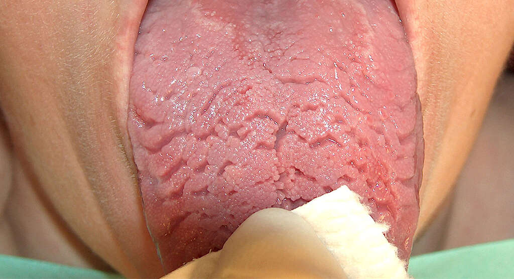 Geographic Tongue